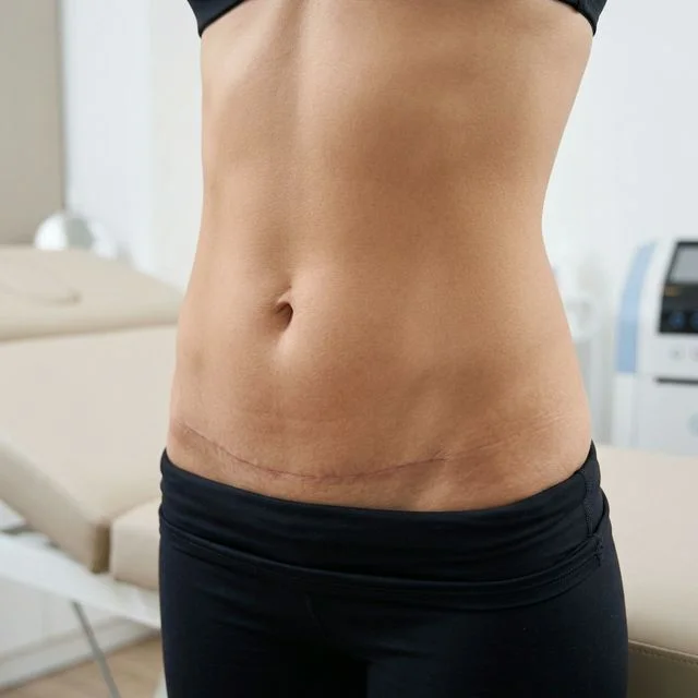 Tummy Tuck (Abdominoplasty) Istanbul | Turkey | OTEMED | GLOBAL HEALING | OTEMED | GLOBAL HEALING