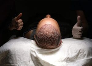 Hair Restoration